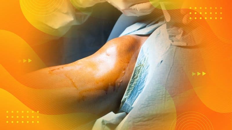 Knee Replacement Surgery Experience in London from Preparation through Recovery