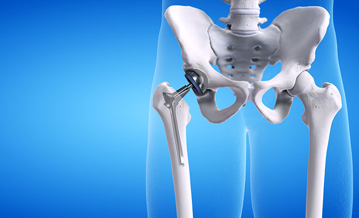 Hip Replacement Cost in Lincolnshire