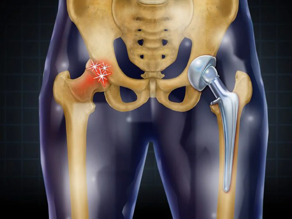7 Effective Physical Therapy Exercises for Hip Replacement Recovery in Steep Hill